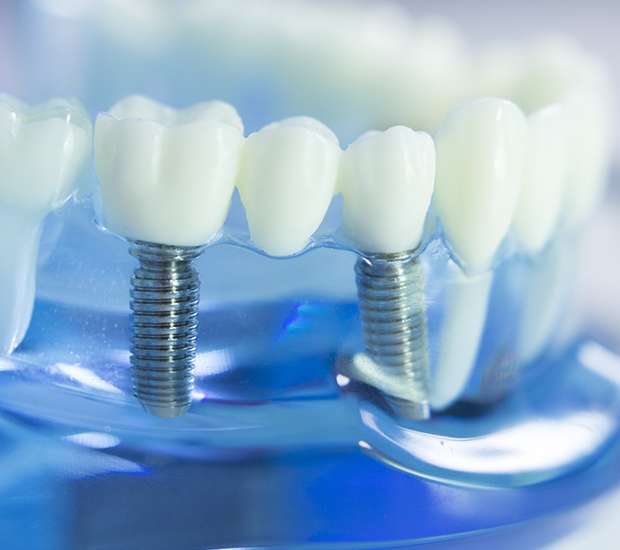 Albuquerque Dental Implants
